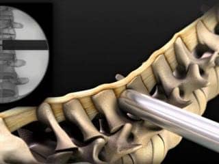 spinal_surgery_animation