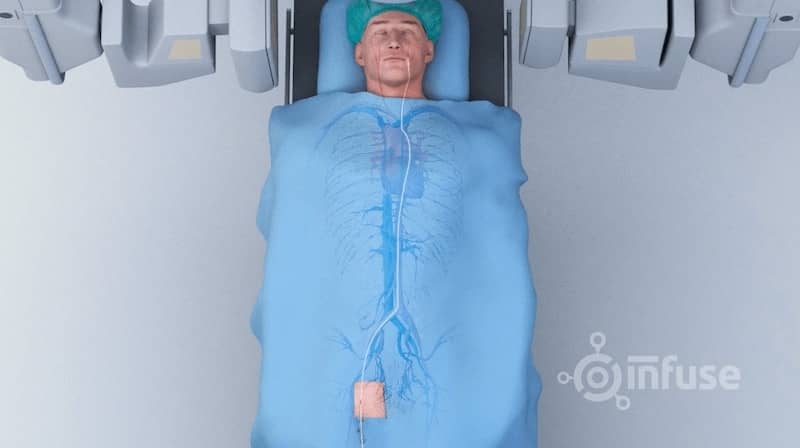 Medical Animations | 3D Animation Studio | Infuse